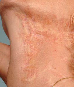 Na behandeling medische tatoeage